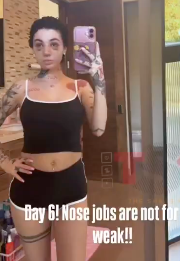 Bhad Bhabie shows off bruising from nose job