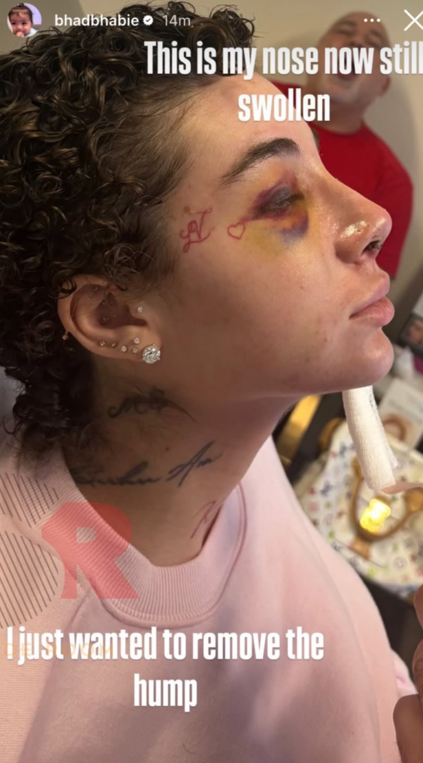 Bhad Bhabie shows off bruising from nose job